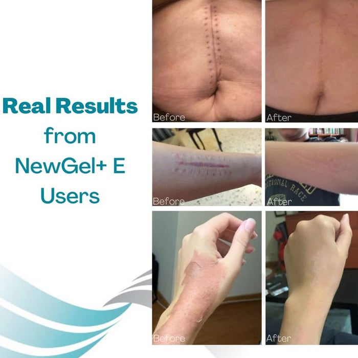 NewGel+E Advanced Medical-Grade Silicone Gel + Vitamin E for All Scar Types 15g Online | myAster UAE