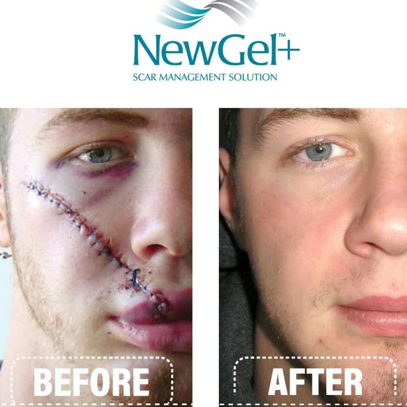 NewGel+E Advanced Medical-Grade Silicone Gel + Vitamin E for All Scar Types 15g Online | myAster UAE