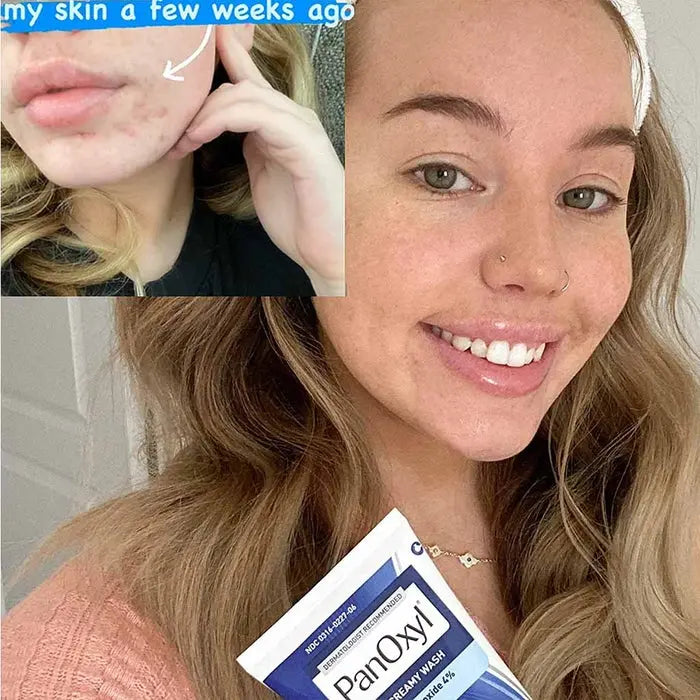 PanOxyl Acne Creamy Face & Body Wash With 4% Benzoyl Peroxide 170g Panoxyl
