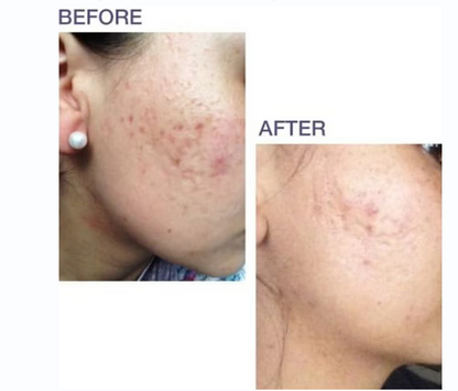 Biodermis prosil spf15 silicone stick for scars 4.25g